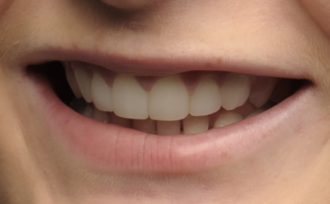 braces for adults  in northern ireland